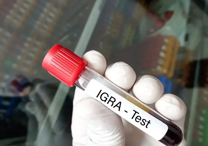 Xét nghiệm Gamma Interferon trong chuẩn đoán nhiễm Lao
